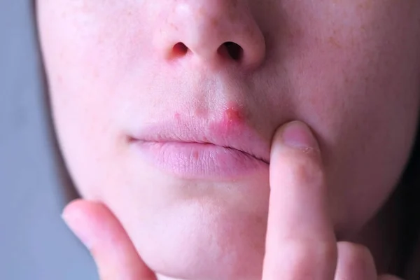 Вирус герпеса на губах. Женщина трогает герпес во рту, крупным планом. . — стоковое фото