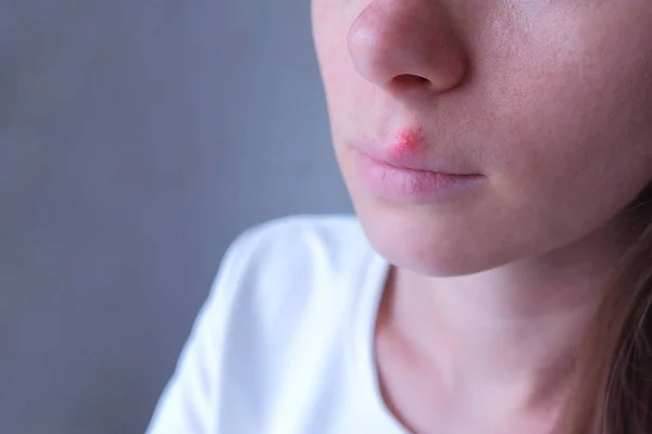 Вирус герпеса на губах. Женщина с герпесом во рту, вид крупным планом . — стоковое фото