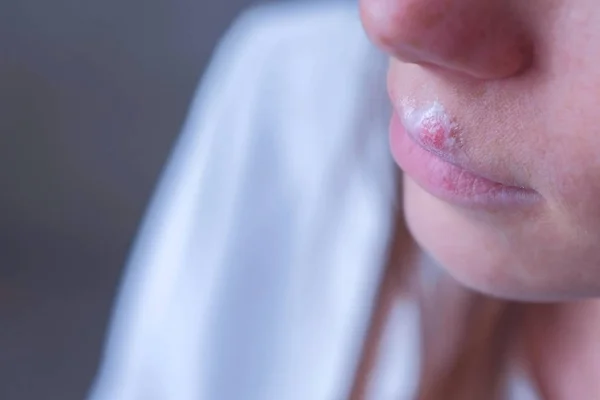 Herpes virus on human lips. Woman with herpes sore on lip mouth with ointment. — Stock Photo, Image