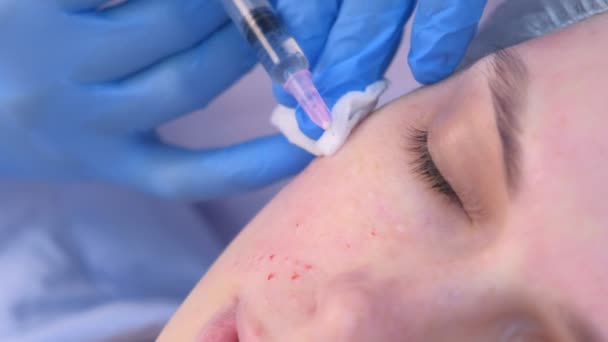 Cosmetologist que faz múltiplas injeções biorevitalization na pele de cara da mulher. — Vídeo de Stock