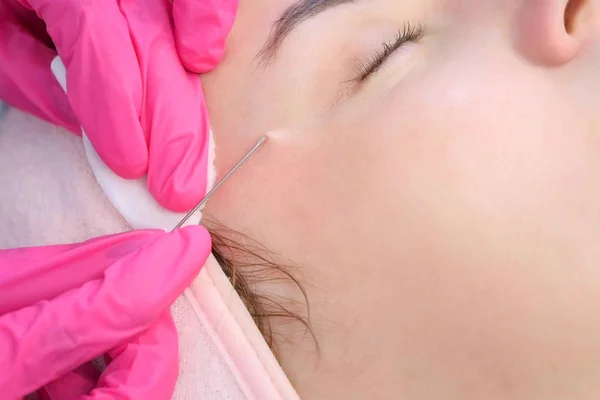 Kosmetolog prikker acne på kvinders ansigt ved hjælp af nål og aftørring bomuldspuder. - Stock-foto