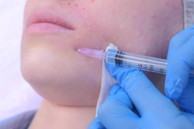 Kozmetik uzmanı kadın cildine birden fazla enjeksiyon yapıyor..