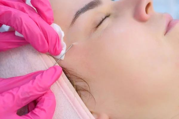 Kosmetolog šťourání akné na ženskou tvář pomocí jehly a otírání bavlněné podložky. — Stock fotografie
