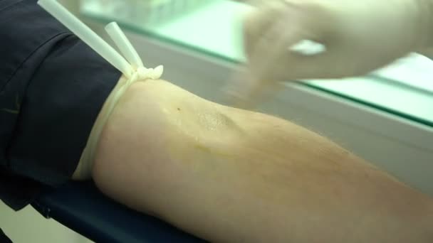 Disinfection Hand Portion Patient Vein Injected — Stock Video