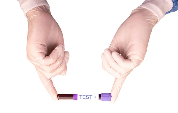 Ruce Drží Zkumavku Obsahující Vzorek Krve Pozitivním Výsledkem Covid Laboratoř — Stock fotografie