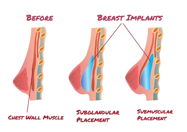 Infografía del implante mamario antes y después — Vector de stock