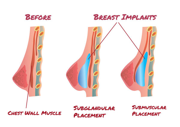 Breast Implant infographic before and after
