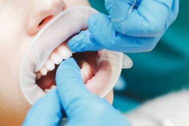 Retraktörü ile kadın ağız kapatın. Doktor diş diş ipi