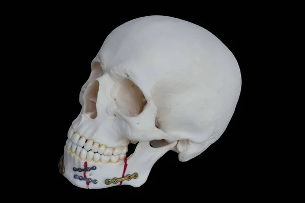 Crânio de resina é mandíbula quebrada — Fotografia de Stock