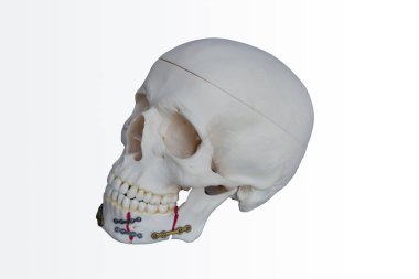 Kafatası reçine yapılmış. Çenesi kırık tabak vida ele geçirmek tespit edildi.