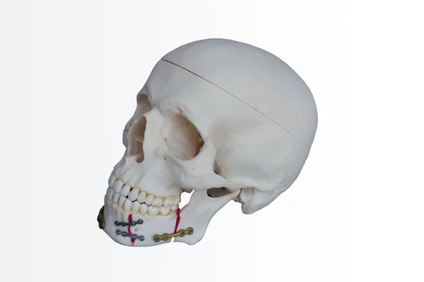 Kafatası reçine yapılmış. Çenesi kırık tabak vida ele geçirmek tespit edildi.