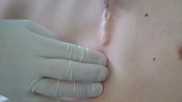 La mano del medico maschio fa un'iniezione al corpo del paziente prima dell'operazione. L'anestesista fa l'anestesia. Pugnalate mediche con ago nelle costole, braccio con guanti chirurgici protettivi. Da vicino. — Video Stock