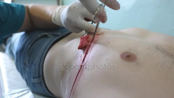 Rukou chirurga vložte svorku do rány a zastavit krev. Detailní záběr