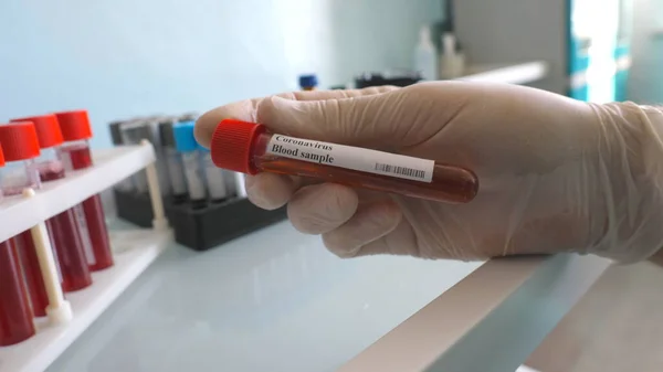戴防护手套的科学家的臂膀用血样对考罗那韦试管进行测试 向Covid 19交验血液样本的实验室工作人员 电晕病毒大流行的概念安全寿命 — 图库照片