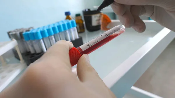 给Covid 19的血样阳性的实验室工作人员的手 科学家用血样检测和检测试管到头孢病毒 电晕病毒大流行的概念安全寿命 — 图库照片