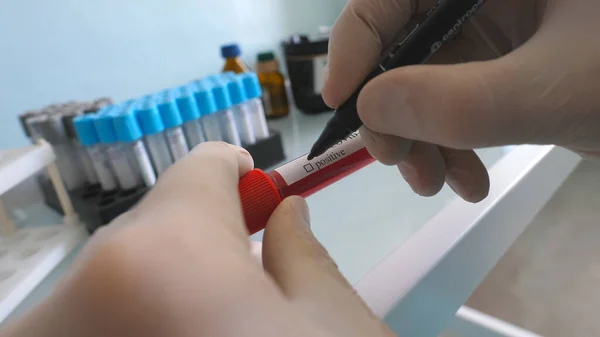 Covid 19に陽性の血液サンプルとしてマーキングされた検査作業員の手 科学者は 血液サンプルを用いた検査管をコロナウイルスに検査します コロナウイルスのパンデミックからの安全性の考え方 — ストック写真