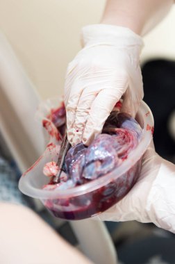 Taze bir plasenta çuvalı, bir ebe tarafından kontrol ediliyor, bir çocuk doğduktan hemen sonra. Tıbbi fotoğrafçılık, kasede taze plasenta. Plasenta kordonu incelemesi