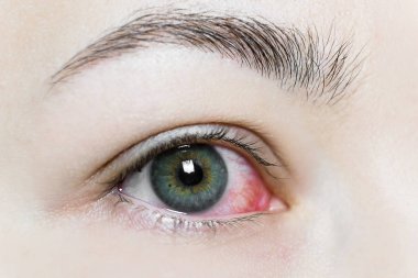 Şiddetli bir kırmızı göze yakın çekim. Viral BlePharitis, Conjunctivitis, Adenovirüsler. Sinirli ya da enfekte olmuş göz..