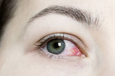 Şiddetli bir kırmızı göze yakın çekim. Viral BlePharitis, Conjunctivitis, Adenovirüsler. Sinirli ya da enfekte olmuş göz..