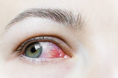 Şiddetli bir kırmızı göze yakın çekim. Viral BlePharitis, Conjunctivitis, Adenovirüsler. Sinirli ya da enfekte olmuş göz..