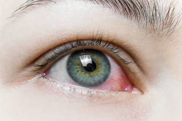 Sluiten van een ernstig bloeddoorlopen rood oog. Virale Blefaritis, Conjunctivitis, Adenovirussen. Geïrriteerde of geïnfecteerde ogen. — Stockfoto