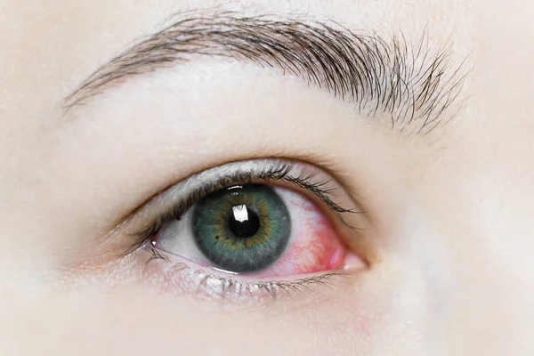 Gros plan d'un œil rouge sanguin sévère. Blepharite virale, conjonctivite, adénovirus. Œil irrité ou infecté . — Photo