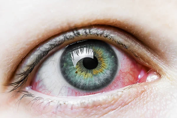 Şiddetli bir kırmızı göze yakın çekim. Viral BlePharitis, Conjunctivitis, Adenovirüsler. Sinirli ya da enfekte olmuş göz..
