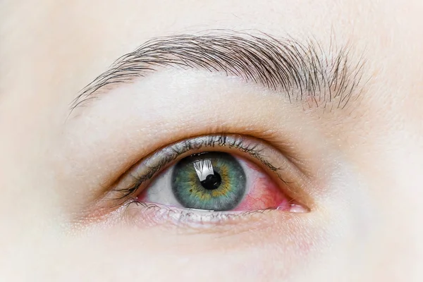 Acercamiento de un severo ojo rojo. Blefaritis viral, conjuntivitis, adenovirus. Ojo irritado o infectado . —  Fotos de Stock