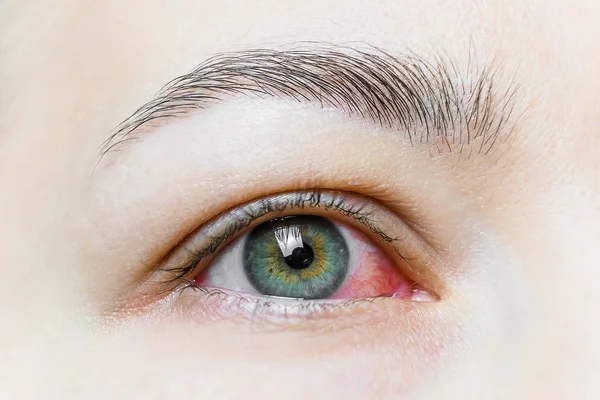 Şiddetli bir kırmızı göze yakın çekim. Viral BlePharitis, Conjunctivitis, Adenovirüsler. Sinirli ya da enfekte olmuş göz..