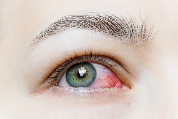 Şiddetli bir kırmızı göze yakın çekim. Viral BlePharitis, Conjunctivitis, Adenovirüsler. Sinirli ya da enfekte olmuş göz..