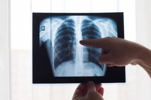 Concepto de radiografía pulmonar. Médico de radiología examinando en radiografía de tórax del paciente Cáncer de pulmón o neumonía. Virus y bacterias infectaron los pulmones humanos. Paciente con cáncer de pulmón o neumonía . — Foto de Stock