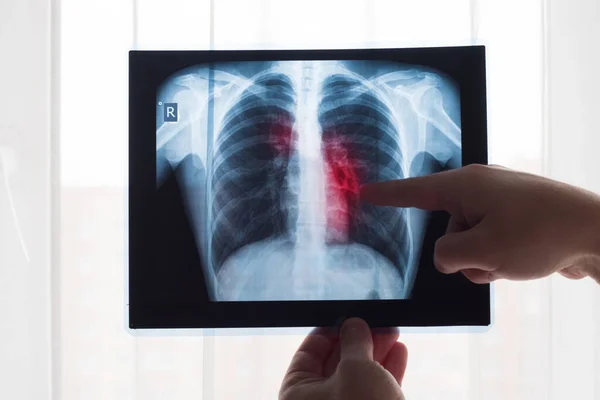 Lung radiography concept. Radiology doctor examining at chest x ray film of patient Lung Cancer or Pneumonia. Virus and bacteria infected the Human lungs. Patient with Lung Cancer or Pneumonia. — Stock Photo, Image