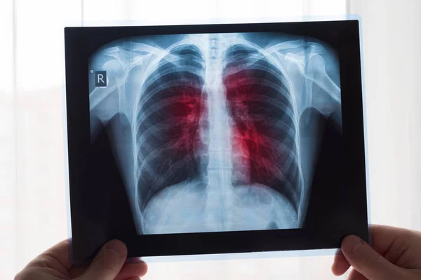 Tüdő röntgen koncepció. Radiológiai orvos vizsgálja mellkasröntgen film beteg tüdőrák vagy tüdőgyulladás. A vírus és a baktérium megfertőzte az emberi tüdőt. Tüdőrákban vagy tüdőgyulladásban szenvedő beteg. — Stock Fotó