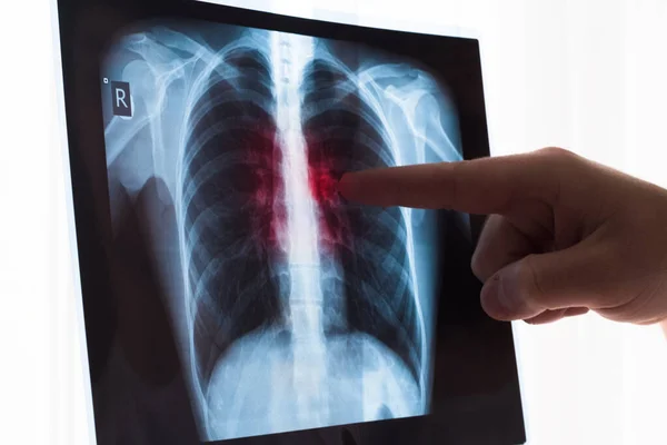 Concepto de radiografía pulmonar. Médico de radiología examinando en radiografía de tórax del paciente Cáncer de pulmón o neumonía. Virus y bacterias infectaron los pulmones humanos. Paciente con cáncer de pulmón o neumonía . —  Fotos de Stock