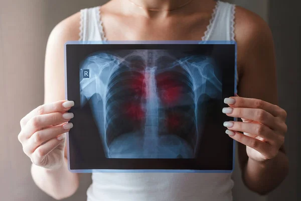 Conceito de radiografia pulmonar. Vírus e bactérias infectaram os pulmões humanos. Doente com cancro do pulmão ou pneumonia . — Fotografia de Stock