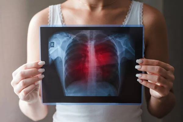 Concepto de radiografía pulmonar. Virus y bacterias infectaron los pulmones humanos. Paciente con cáncer de pulmón o neumonía . — Foto de Stock