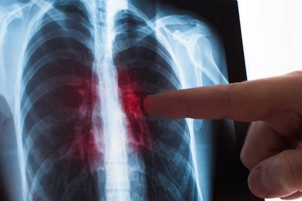 Akciğer radyografi konsepti. Radyoloji doktoru, akciğer kanseri ya da zatürree hastasının röntgenini inceliyor. Virüs ve bakteri insan ciğerlerine bulaştı. Akciğer kanseri veya zatürree hastası.. — Stok fotoğraf