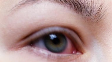 Şiddetli bir kırmızı göze yakın çekim. Viral BlePharitis, Conjunctivitis, Adenovirüsler. Tahriş ya da enfeksiyon kapmış göz. Corona virüsü