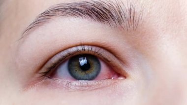 Şiddetli bir kırmızı göze yakın çekim. Viral BlePharitis, Conjunctivitis, Adenovirüsler. Tahriş ya da enfeksiyon kapmış göz. Corona virüsü