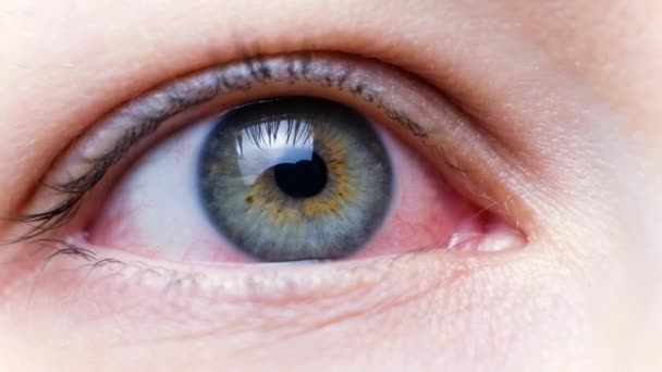 Acercamiento de un severo ojo rojo. Blefaritis viral, conjuntivitis, adenovirus. Ojo irritado o infectado. Virus Corona — Vídeo de stock