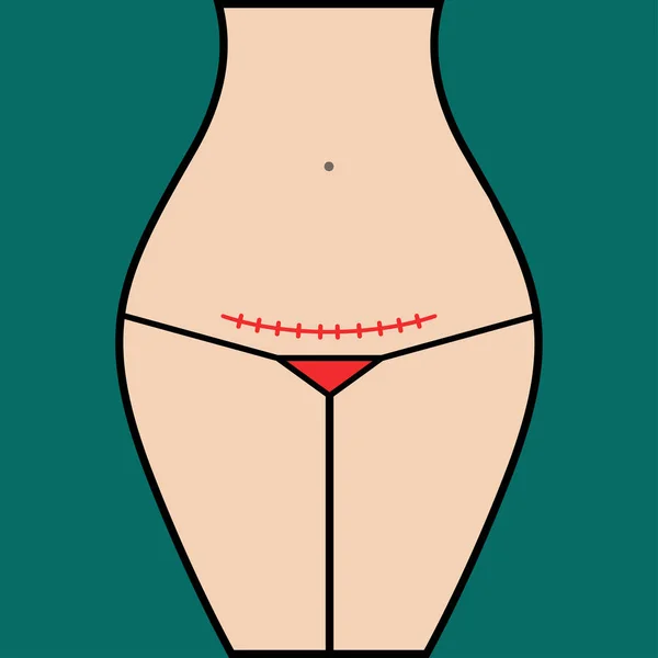 剖宫产术后缝合 — 图库矢量图片