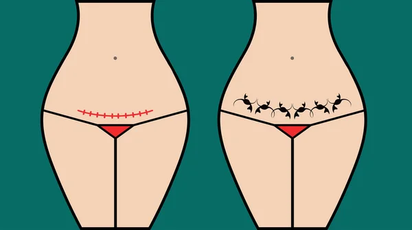 Maszkolás cesarea scar szakasz tetoválás — Stock Vector