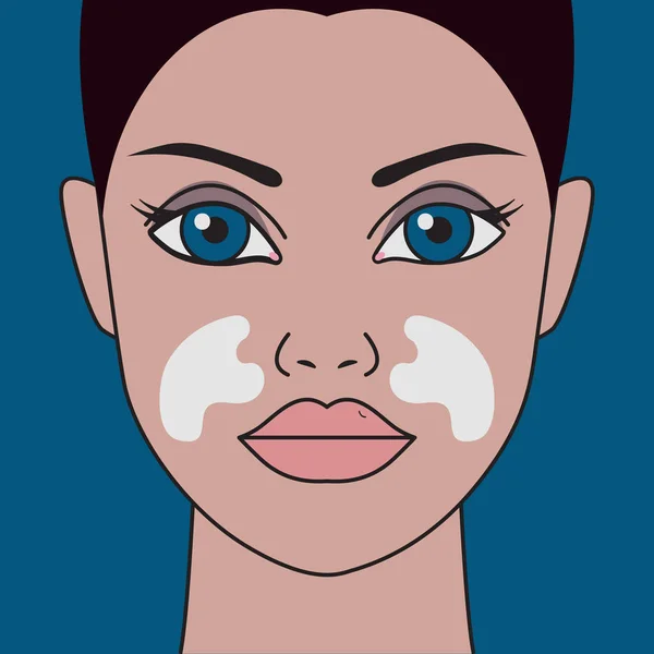 Girl with vitiligo — Stock Vector