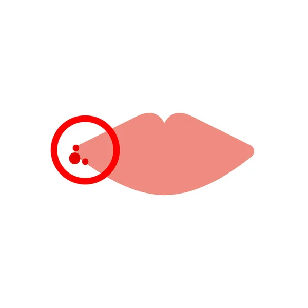 Herpès sur les lèvres — Image vectorielle