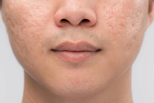 Rosto masculino com cicatrizes de acne — Fotografia de Stock