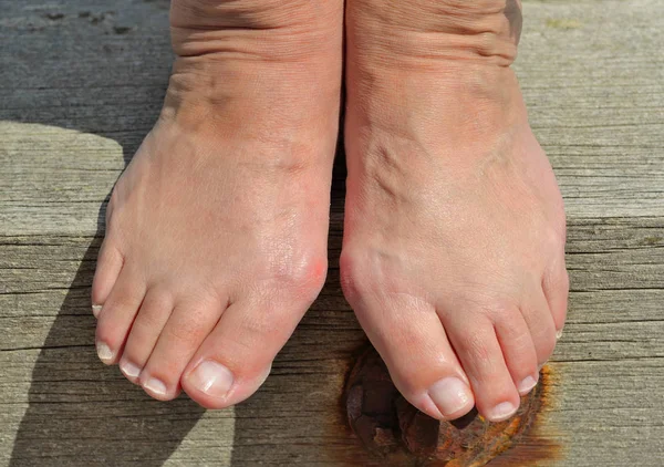 Bunions a painful, bony lump that can develop on the side of your foot — Stock Photo, Image