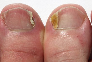 Fungal Nail Infection  on big toes clipart