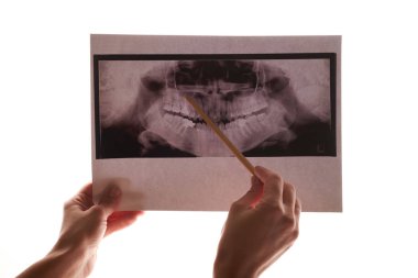 çene ve diş röntgen tutan el