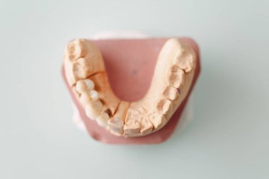 Dişleri ve implantları olan insan çenesinin diş yapısı. Üst görünüm.
