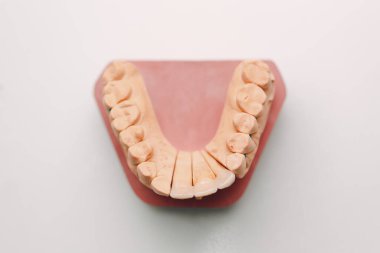 Dişleri ve implantları olan insan çenesinin diş yapısı.